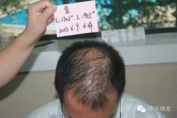 顶秃植发价格深度解析与指南