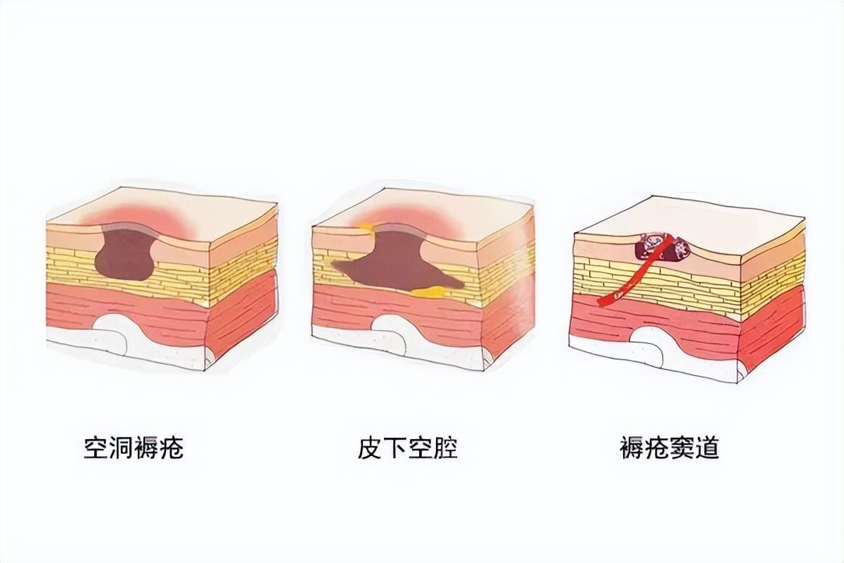 褥疮分期新标准及其应用简介